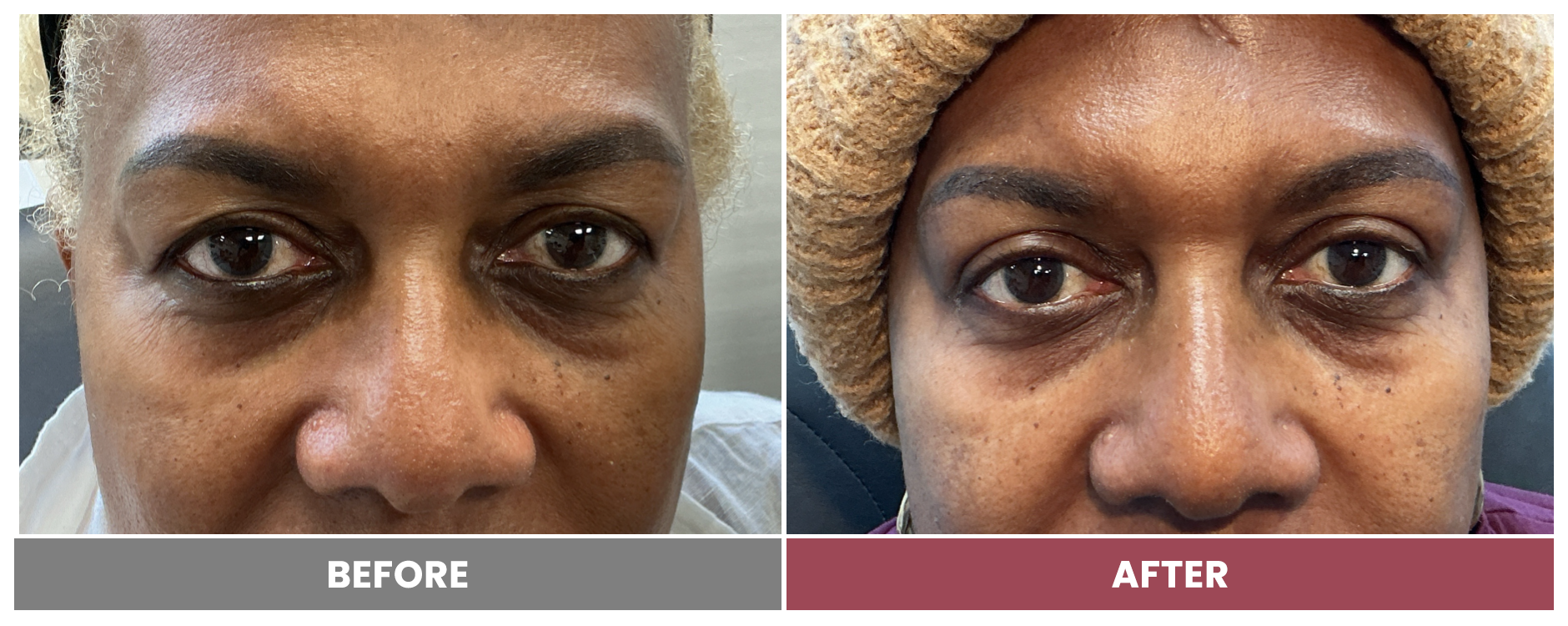 Upper Blepharoplasty - Case leslyn-roman